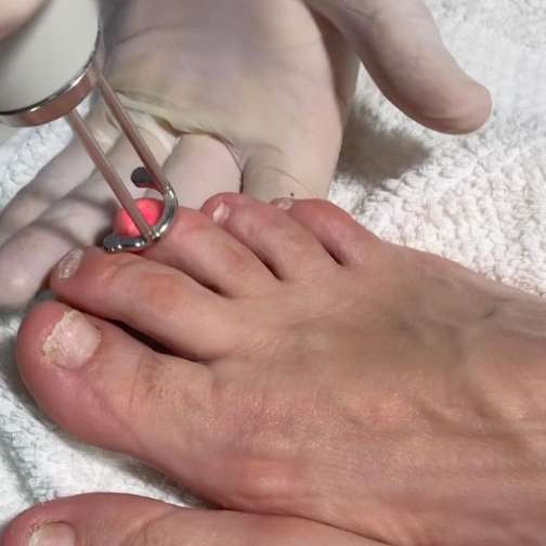 Láser dermatológico