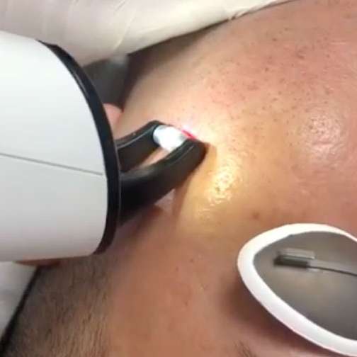 Láser para cicatrices