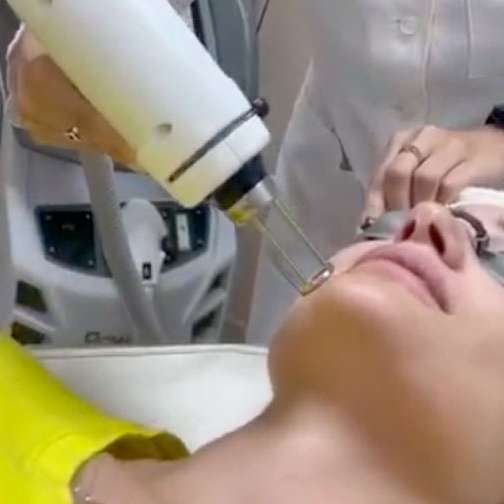 Láser de rejuvenecimiento facial