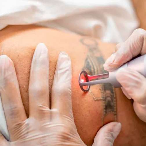 Láser de eliminación de tatuajes