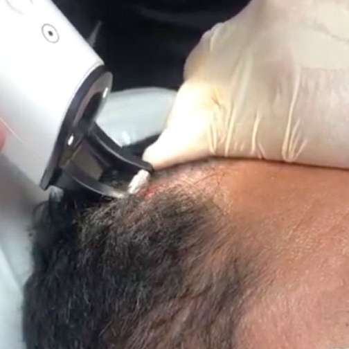 Láser para recuperación capilar